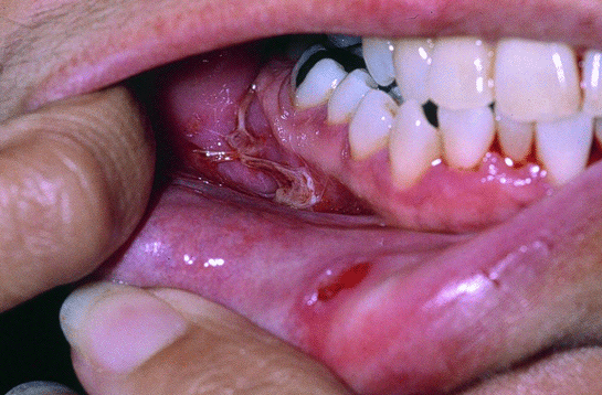 Diş Eti İltihabı İle İlgili Dikkat Edilmesi Gerekenler İlaç Çeşitleri
